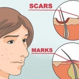 Slip af med acne røde pletter