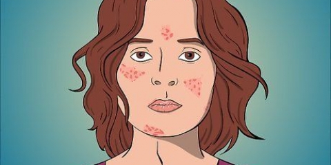 Afhjælpe acne med cystedannelse
