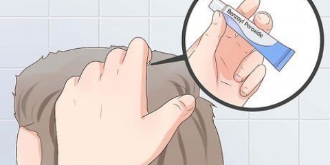 Behandl acne i din hovedbund