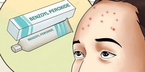 Slip af med acne på din pande