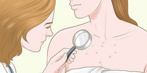 Slip af med acne ar på brystet