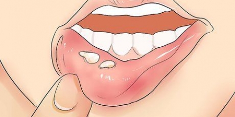 Genkender herpes