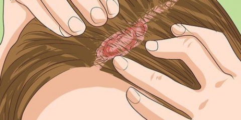 Genkender psoriasis i hovedbunden