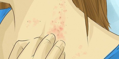Behandling af svampehudinfektioner: kan det naturligt?