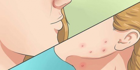 Slip af med acne hurtigt og naturligt