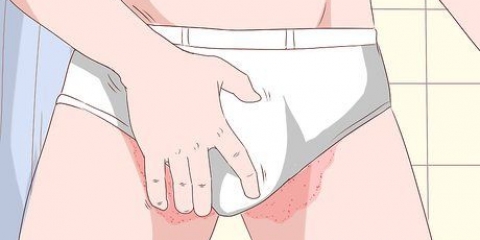 Behandling af tinea cruris med sudocrem