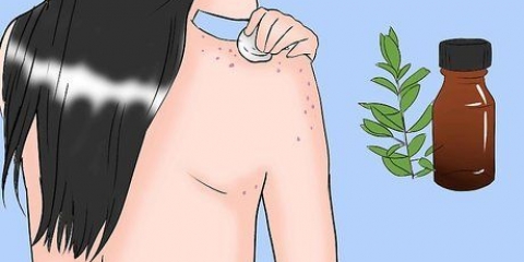 Slip af med acne på din krop