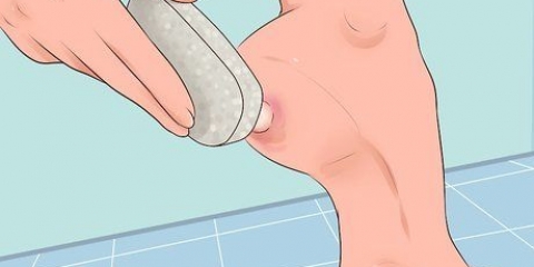 Slip af med en vorte under din fod