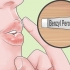Behandl hurtigt acne omkring læberne