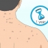 Slip af med acne ar på ryggen