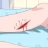 Behandling af cellulite