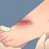 Behandling af dybe snit