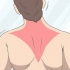 Gendannelse af en trapezius-stamme