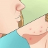 Slip af med acne hurtigt og naturligt